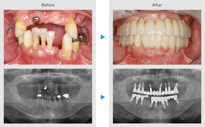 implant05